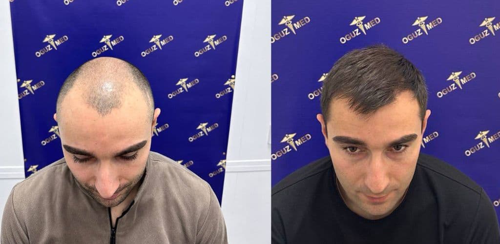 До · После