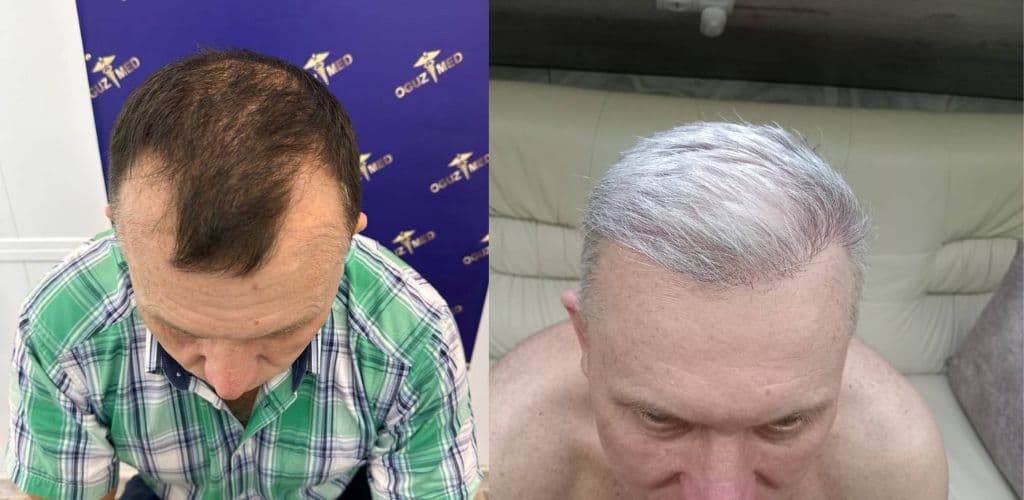 До · После
